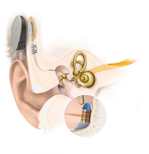 Anatomische Grafik eines implantierten Mittelohr Hörimplantate